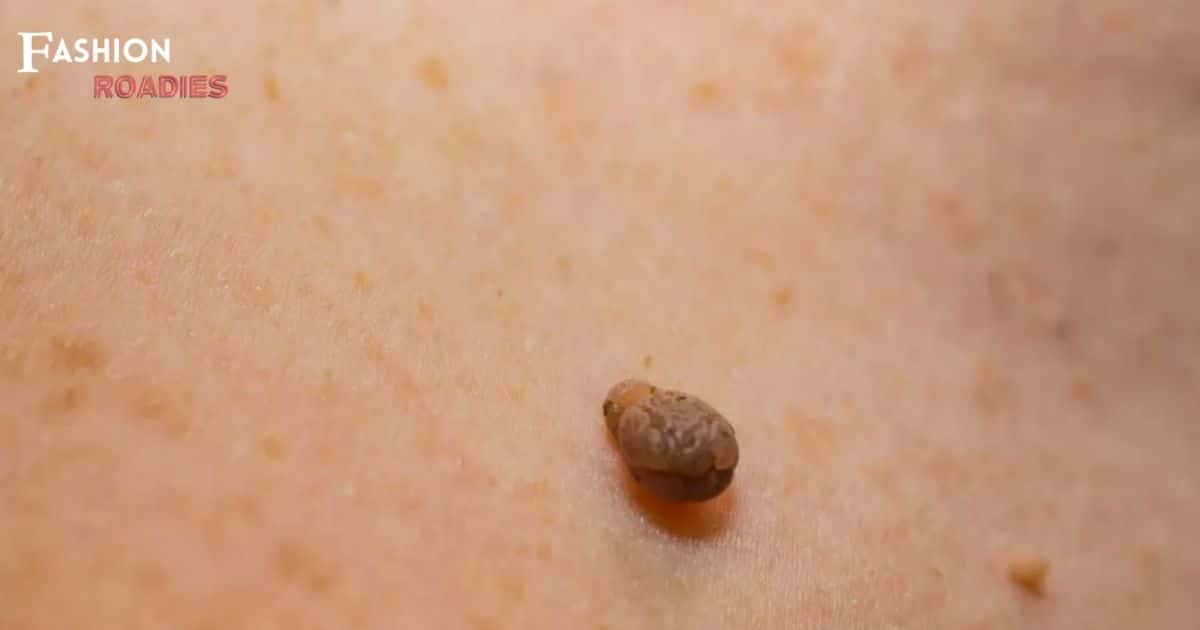 Difference Between Skin Tag and Wart