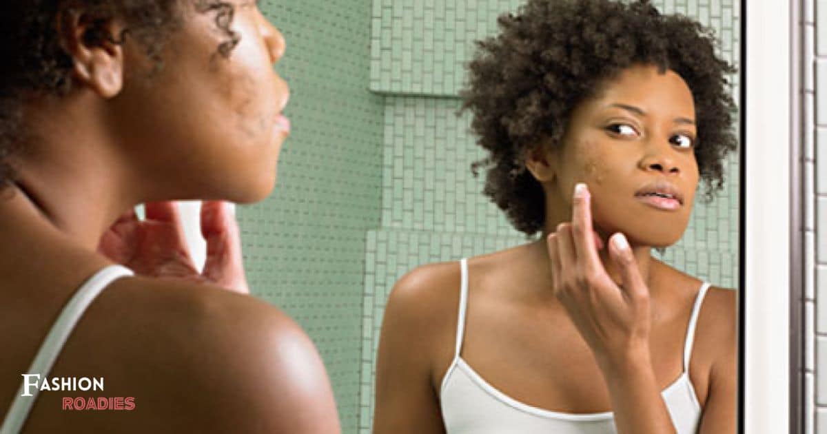 Managing Acne and Breakouts in Black Skin